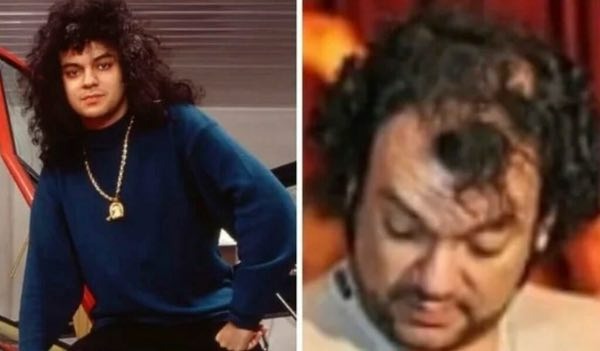 Matyt, tai priklauso nuo amžiaus. Juk Kirkorovui jau 52 metai. Maždaug šiame amžiuje vyrai pradeda plikti. Deja, dainininkė šios problemos neišvengė. Mes, žinoma, to nepastebime, nes dainininkė naudoja peruką.   Tačiau atostogų metu Filipas šio aksesuaro atsisako. Ir tada ant jo galvos jau matosi plikė.