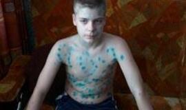 Vėjaraupiais geriau sirgti vaikystėje