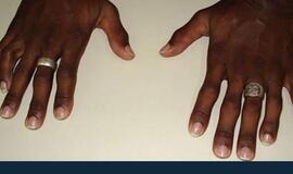 Prekeivį narkotikais išdavė 12 rankos pirštų