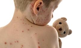 Saugokime vaikus nuo vėjaraupių