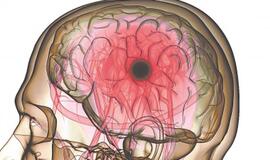 Kamieninių ląstelių tyrimas teikia vilties patyrusiems insultą