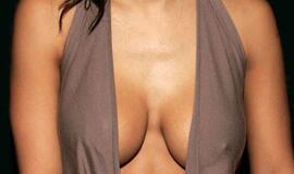 Dažniausia plastinė operacija Vokietijoje - krūtų didinimas