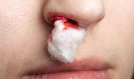 Už frazę "Atsikabink, ožy" metaliniu strypu sukruvinta nosis