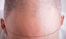 Planuojama pirmoji žmogaus galvos transplantacija