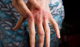 Apie žvynelinę - iš specialistų lūpų