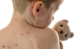 Lietuvoje daugėja susirgimų vėjaraupiais