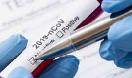 JAV sukurtas testas, nustatantis koronavirusą kraujyje per parą nuo užsikrėtimo