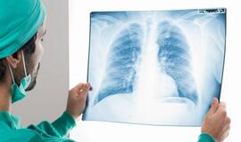 Plaučių transplantacija – išskirtinė ir labai laukiama operacija