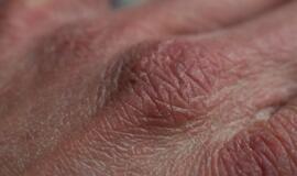 Sausa ir sudirgusi oda? Patarimai, kaip išspręsti šią problemą