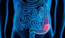 Kolorektalinis vėžys: gerai užsimaskavusi liga, apie kurią kalbėti būtina