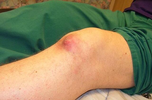 Pirmą kartą Lietuvoje persodintas meniskas