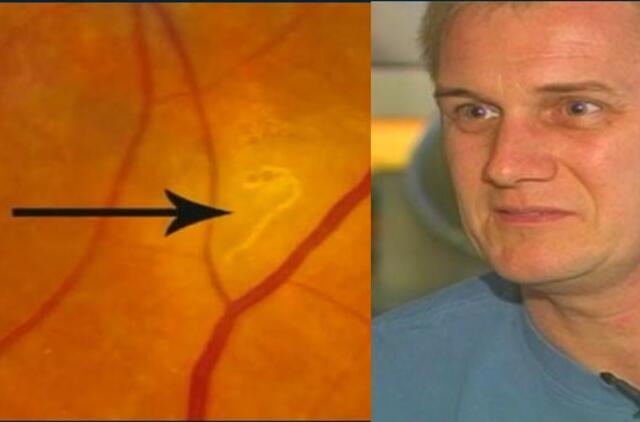 Gydytojai vyrui iš akies pašalino kirminą