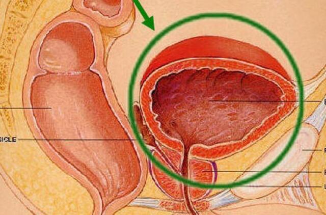 Nerimaujama dėl sumažinto prostatos vėžio prevencijos programos finansavimo