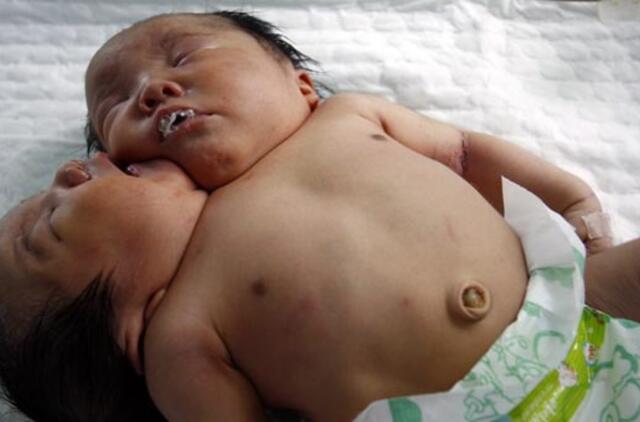 Kinijoje gimė mergaitė su dviem galvomis