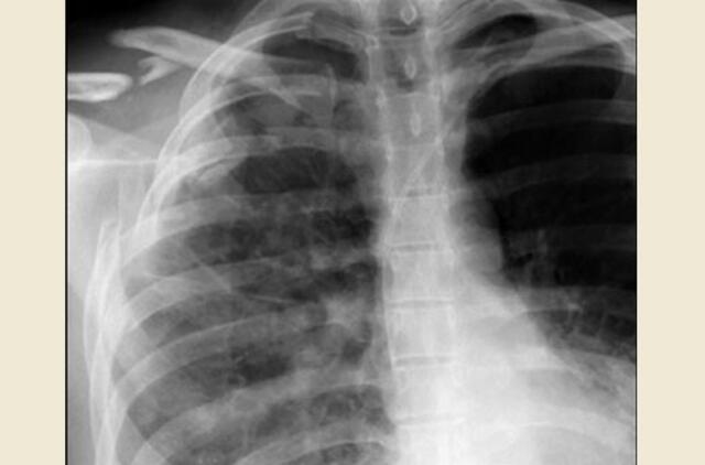 Telšiškis sulaužė policininko šonkaulį smūgiu alkūne