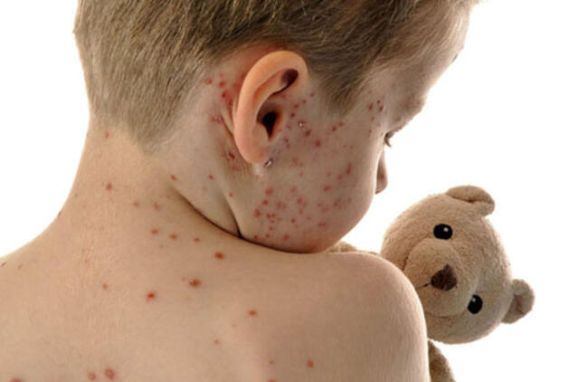 Po atostogų - vėjaraupiai