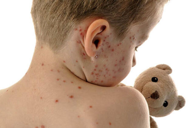 Klaipėdos rajone sergama ir skarlatina