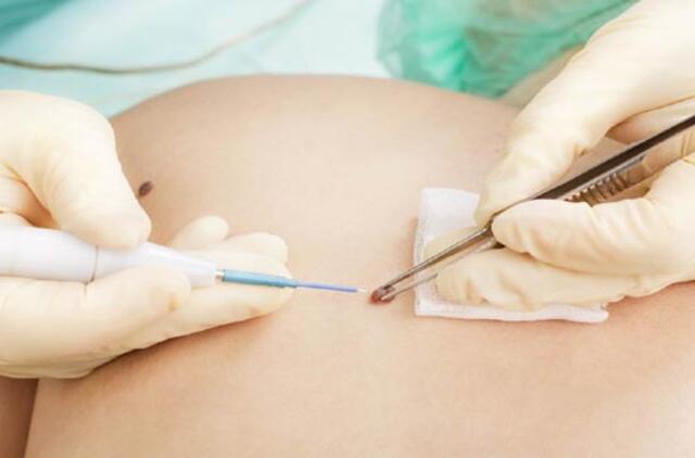 Sergančiųjų melanoma kasmet daugėja