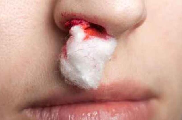 Ramygaloje paaugliui nosį sulaužė bendramokslis