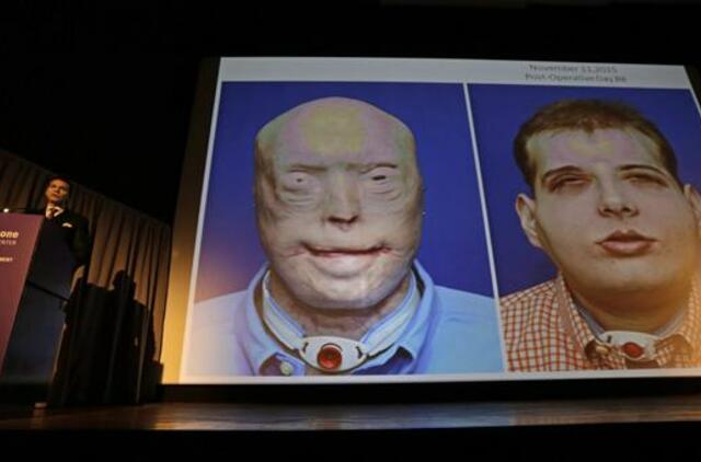 JAV ugniagesiui persodintas didžiausias pasaulyje veido transplantas