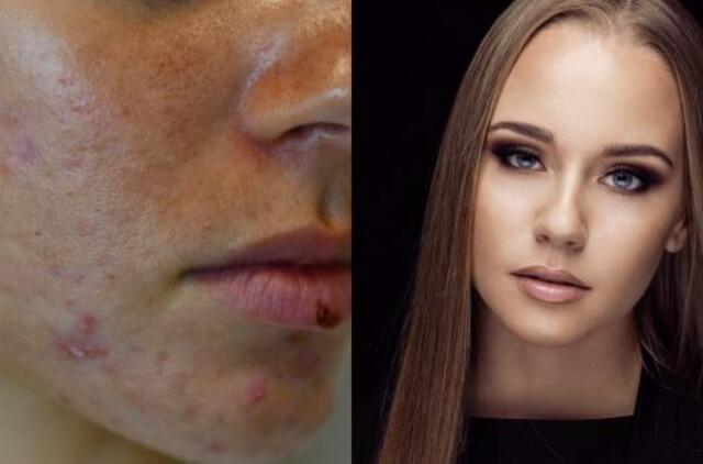 Specialistai: nesprendžiamos odos problemos sukelia psichologinių sunkumų, gali trukdyti siekti karjeros