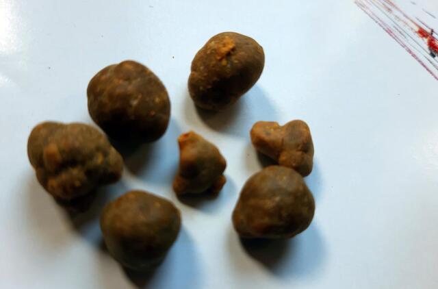 Tulžies pūslės akmenys