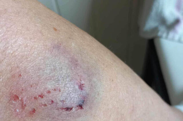 SKAUDŽIAI. Virtualioje erdvėje paviešinta nuotrauka, kurioje matosi savaitgalį moterį užpuolusios šuns paliktos įkandimo žymės.  „Facebook“ grupės „Tauralaukio Bendruomenė“ nuotr.